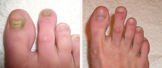 Результаты лазерного лечения грибка ногтей